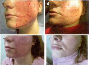 Stadien der Hautrestauration nach dem fraktionierten Ablationsverfahren