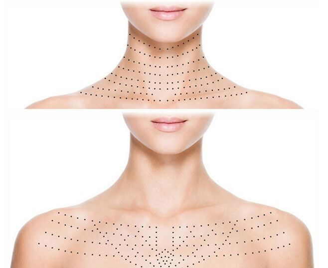 Markierung auf der Haut von Hals und Dekolleté für eine verjüngende Biorevitalisierung