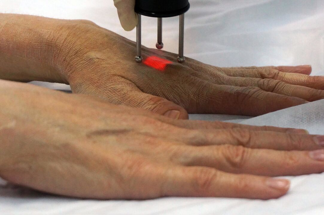 Laserverjüngung der Hände mit einer nicht-ablativen Methode