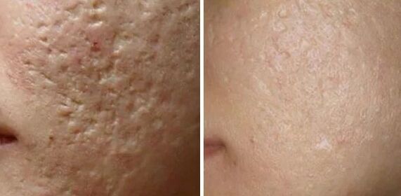Scars Laser Erdung