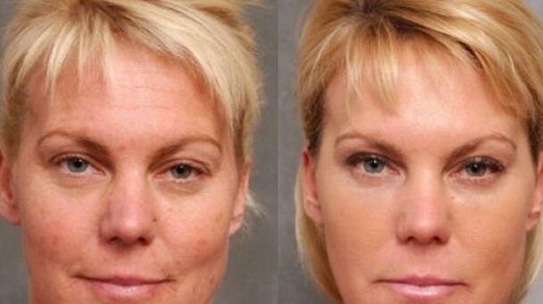 Vor und nach dem Verjüngungsverfahren