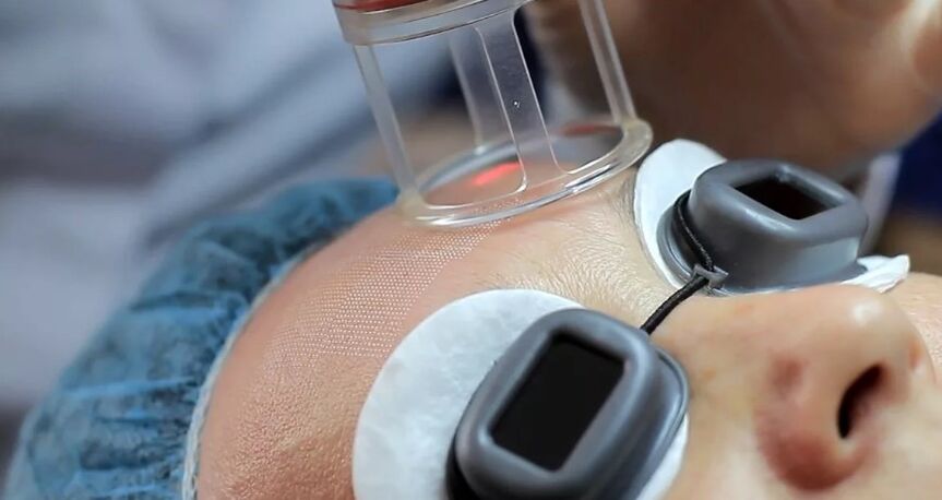 Feldlaser